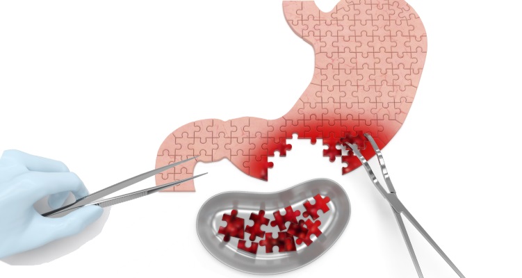 Revizyonel Obezite Cerrahisi Nedir?