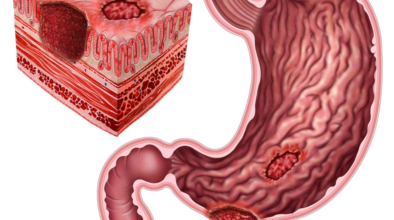 Mide Ülseri: Belirtileri ve Cerrahi Tedavi Seçenekleri Nelerdir? 