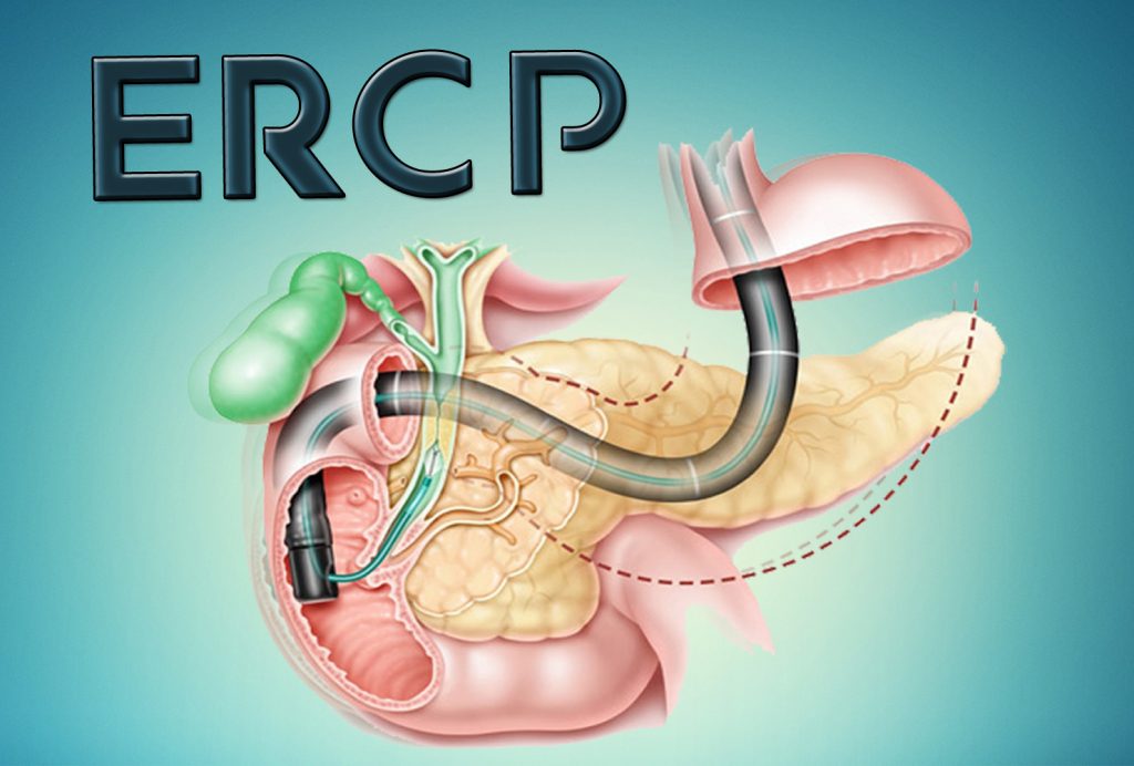 ERCP (Endoskopik Retrograd Kolanjiopankreatografi) Nedir?