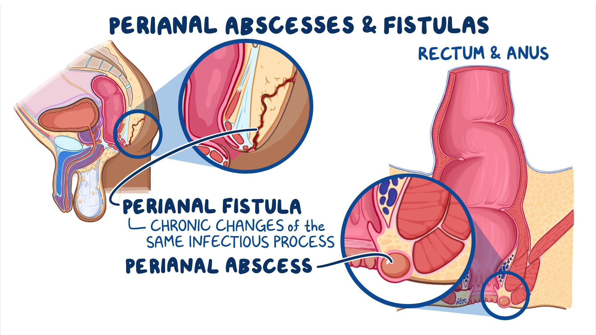 Makat Apsesi (Perianal Apse) Nedir?