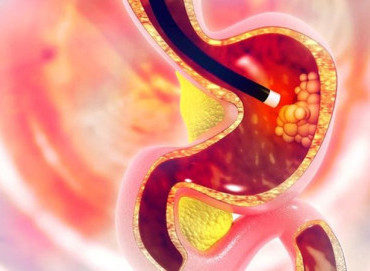 mide biyopsisi nedir, nasıl yapılır