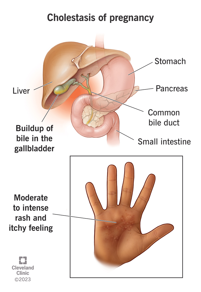 İntrahepatik Kolestaz ve Gebelik: Tanı ve Tedavi Süreci