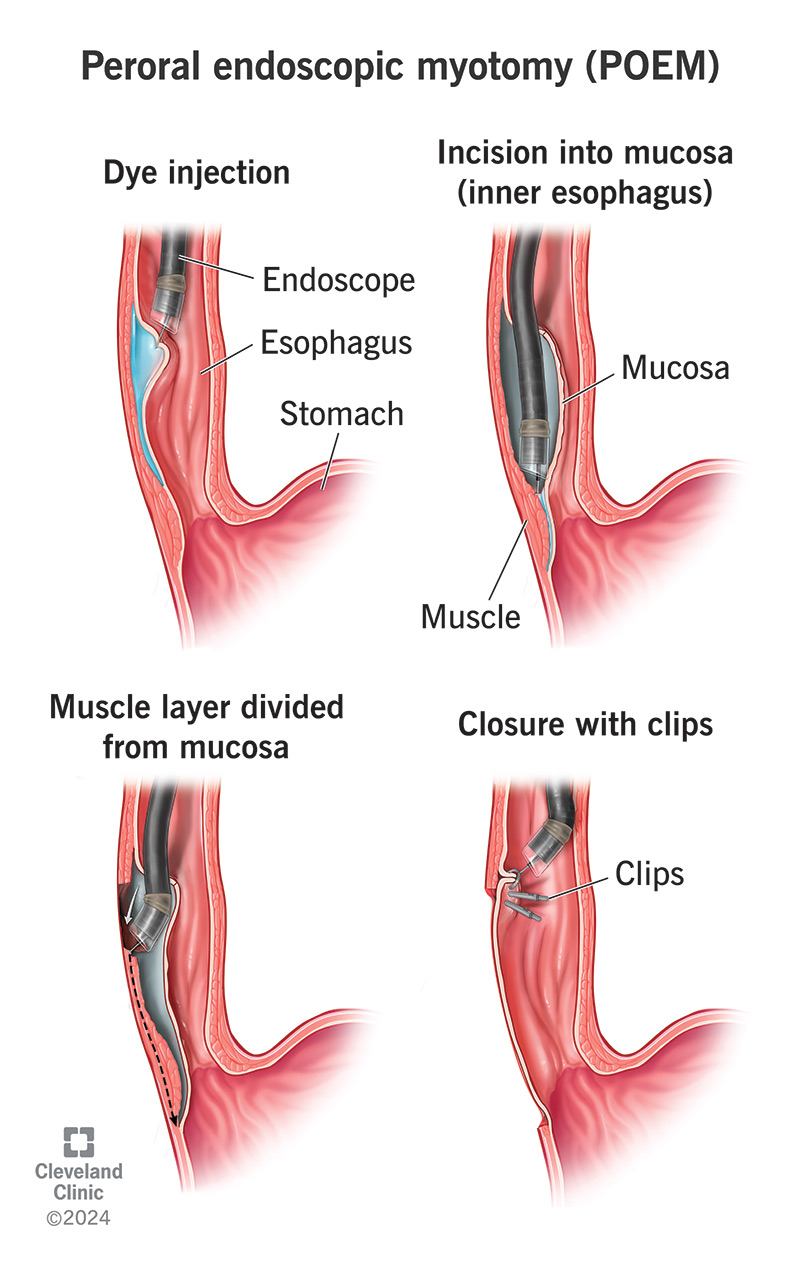 POEM ameliyatı sonrası iyileşme süreci
