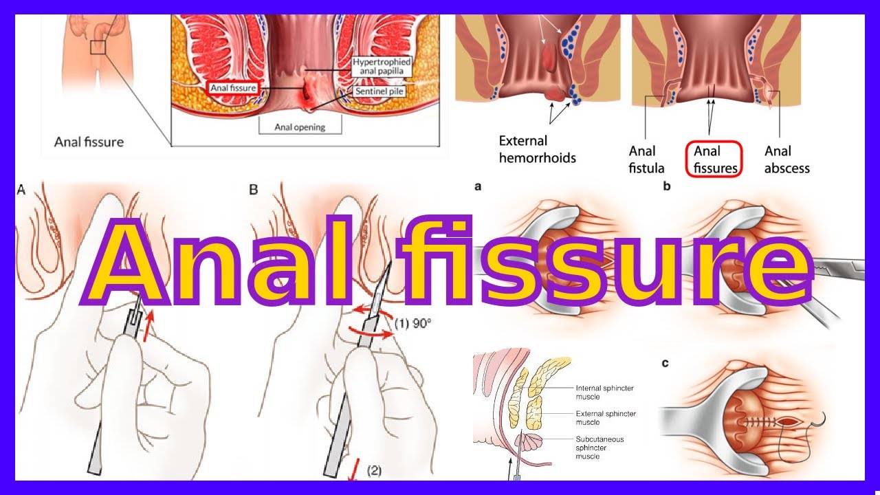 Makat Çatlağı (Anal Fissür) Nedir?