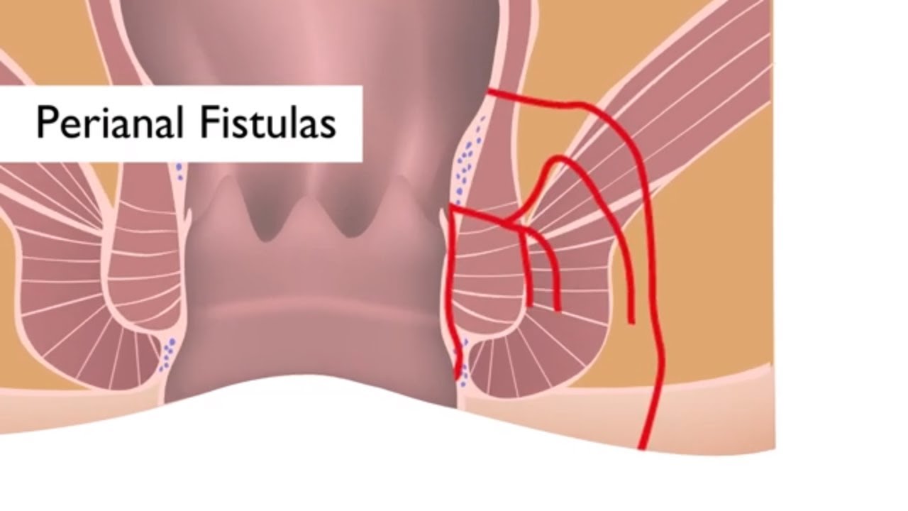 Perianal Fistül Nedir?