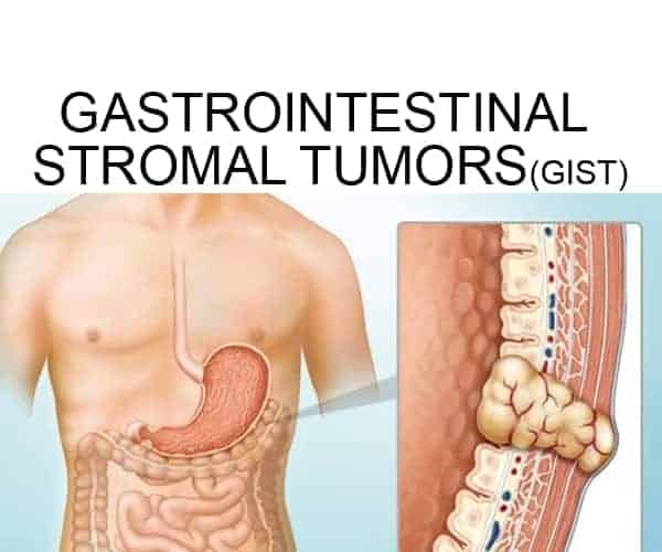 GIST (Gastrointestinal Stromal Tümörleri): Minimal Invaziv Cerrahi Seçenekleri