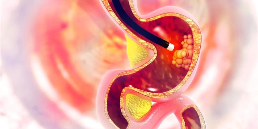 mide biyopsisi nedir, nasıl yapılır