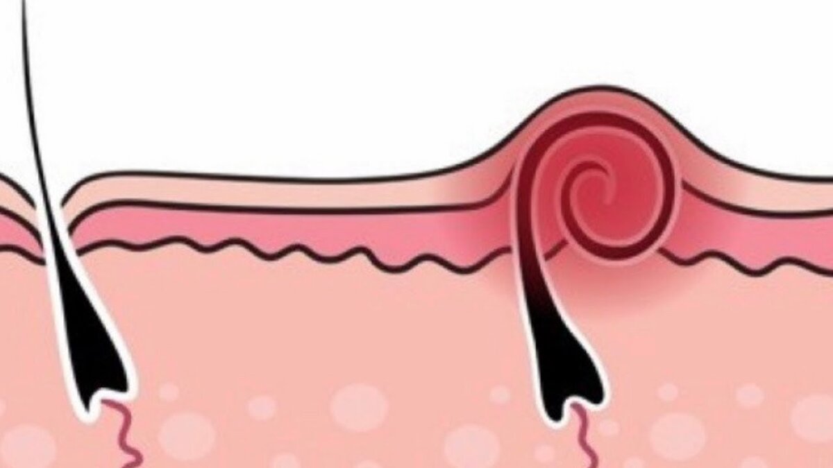 Kıl Dönmesi Nedir?