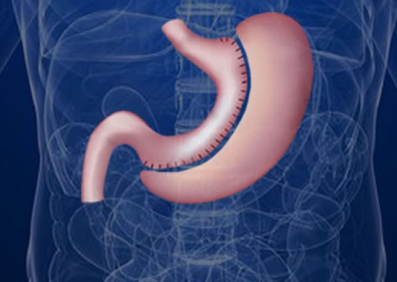 Tüp Mide Ameliyatında Kaç Gün Hastanede Yatılır?